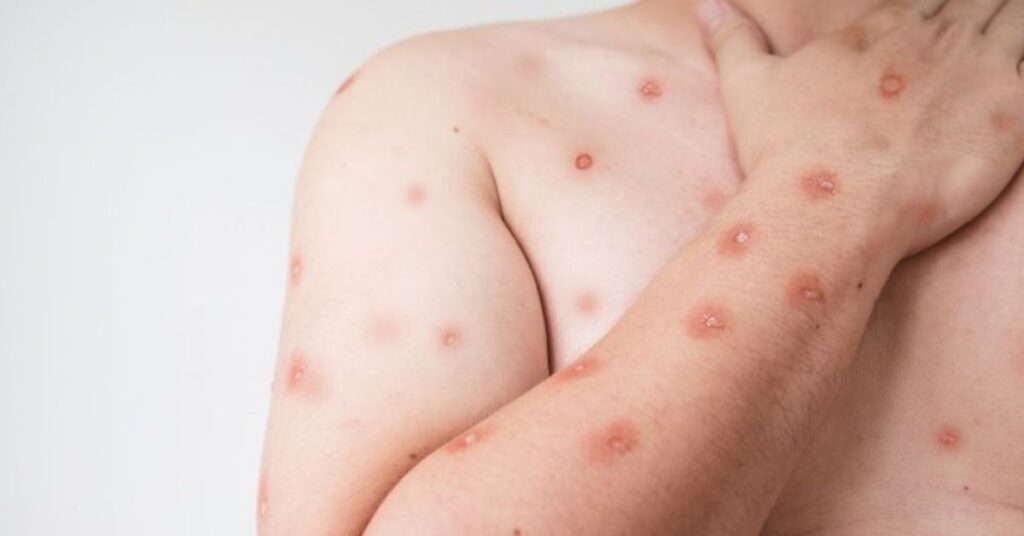 Lesões de mpox na pele de paciente com infecção viral monitorada no Brasil