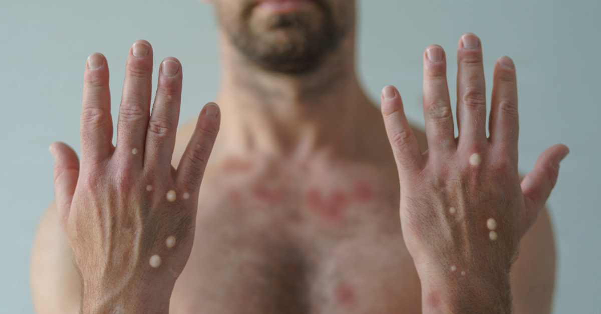 Lesões de Mpox nas mãos e pele de paciente com sintomas da doença viral - Foto: ITPS/Reprodução